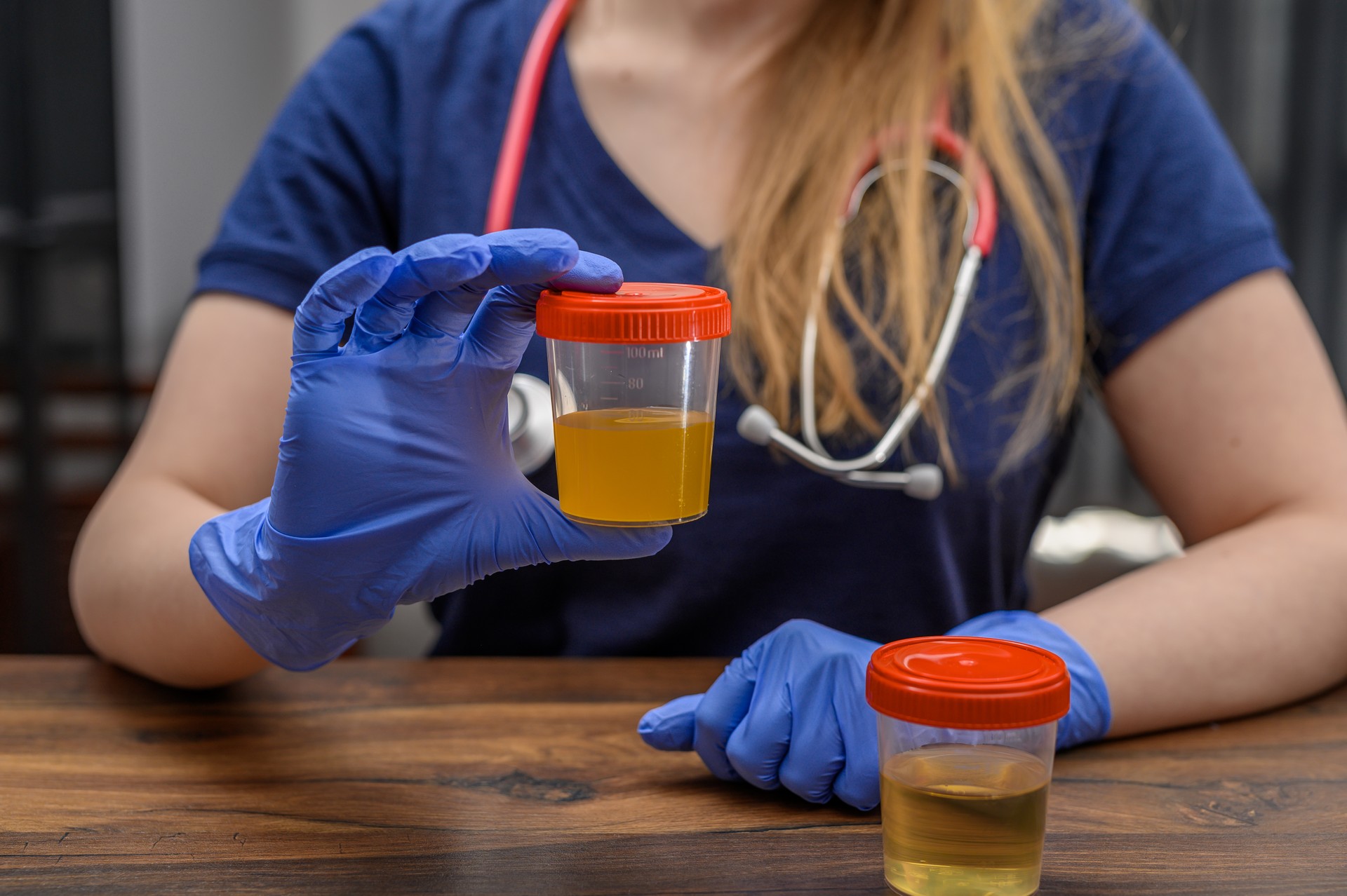 Thick orange cloudy urine, sample in a container for analysis